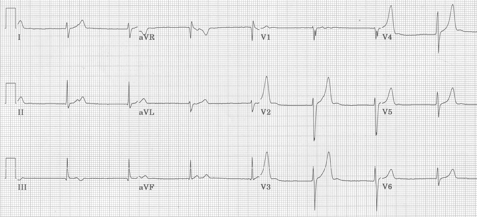 Junctional Rhythms Introduction